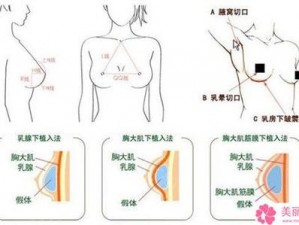 乳房悬吊术【乳房悬吊术会影响哺乳吗？】